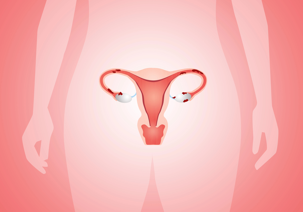 Sintomas de Endometriose